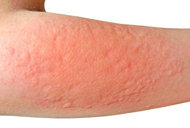 Deri döküntüleri, alerji temas dermatiti, kimyasallara alerjisi, maruz kalmaktan kaynaklanan mantar enfeksiyonları.                               