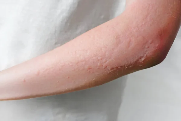 Éruptions Cutanées Dermatite Contact Allergique Allergie Aux Produits Chimiques Infections — Photo