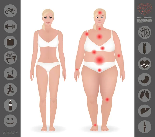 Cuerpo de una mujer, grueso y delgado, puntos de dolor, vector detallado i — Vector de stock