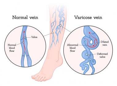 Everted leg varicose