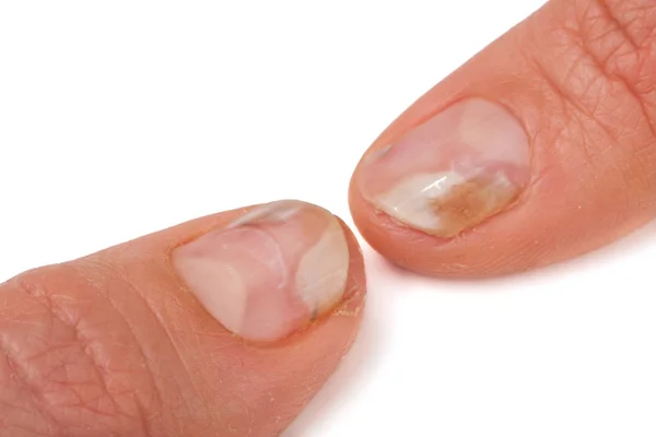 Two fingers of the hand with a fungus on the nails isolated  white background — Stock Photo, Image