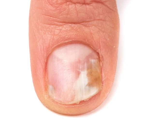 Un dito della mano con un fungo sulle unghie isolato sfondo bianco — Foto Stock