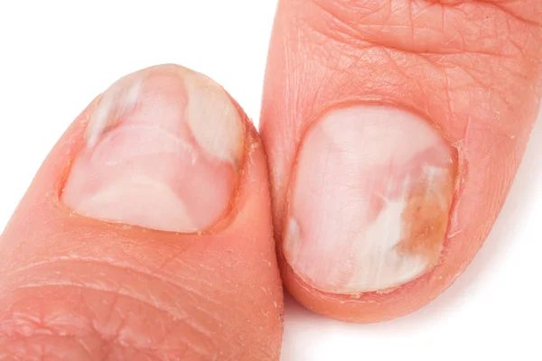 Due dita della mano con un fungo sulle unghie isolato sfondo bianco — Foto Stock