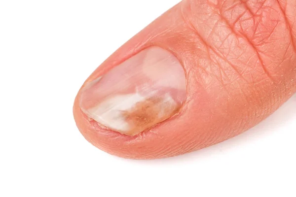 Jeden palec ręki z grzybem na paznokcie na białym tle biały — Zdjęcie stockowe