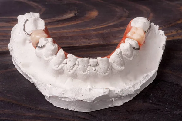 Yeso de dientes con dentadura parcial extraíble sobre un fondo de madera oscura —  Fotos de Stock