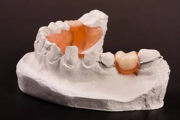 plaster cast of teeth with removable partial denture on a dark background