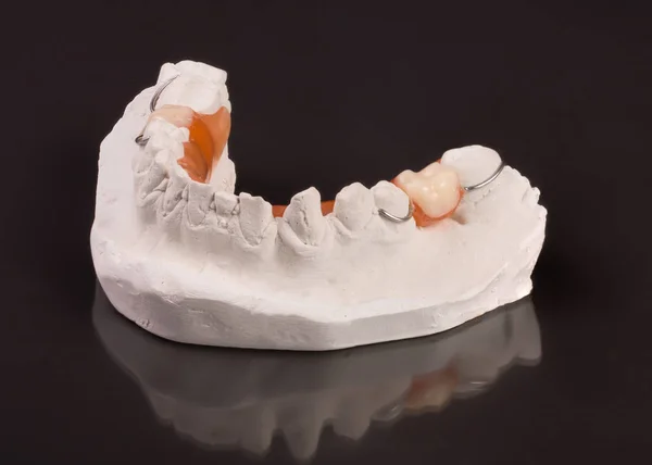 Yeso de dientes con dentadura parcial extraíble sobre un fondo oscuro —  Fotos de Stock