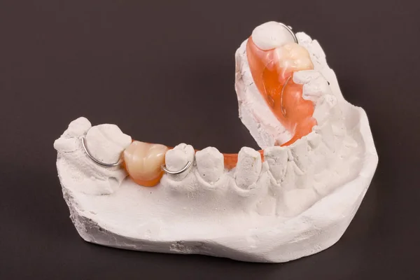 Gipsen van tanden met verwisselbare partiële prothese op een donkere achtergrond — Stockfoto