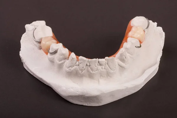 Gipsowy zębów z protezą częściowe na ciemnym tle — Zdjęcie stockowe