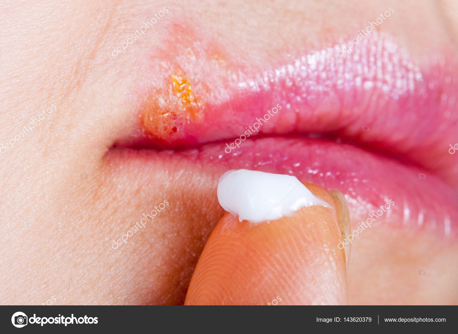 Herpes boca pomada na