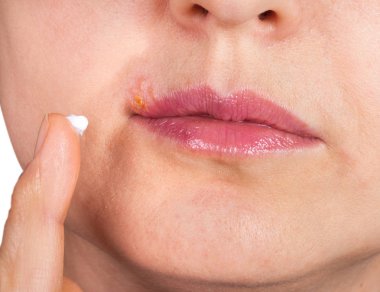 Herpes dudak yakın çekim makro üzerinde. Kadın dudaksı herpes merhem yağlar