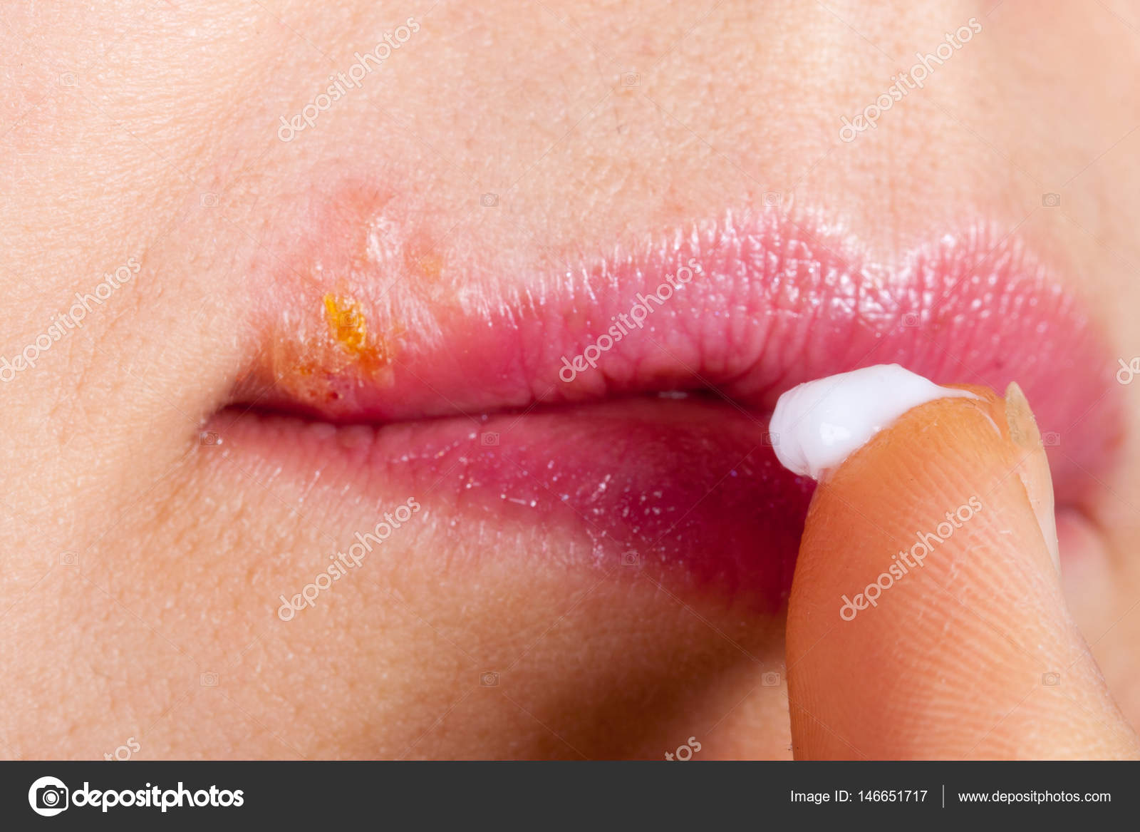 Pomada herpes na boca
