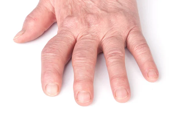 Rheumatoid polyarthritis of hands isolated on white background — Stock Photo, Image