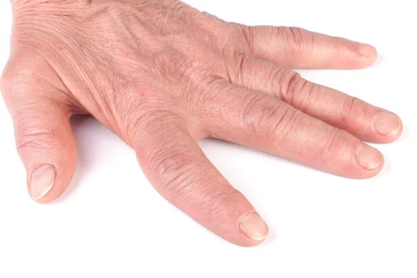 Ρευματοειδής πολυαρθρίτιδα των χεριών που απομονώνονται σε λευκό φόντο — Φωτογραφία Αρχείου