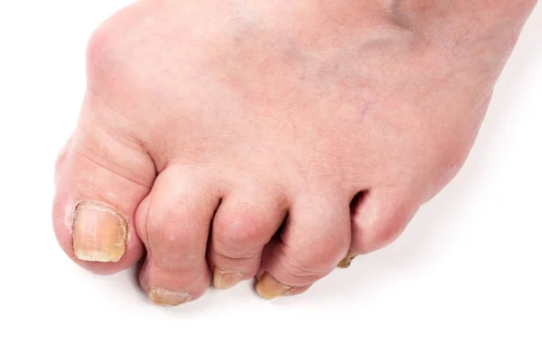Rheumatoid polyarthritis on foot isolated on white background — Stock Photo, Image