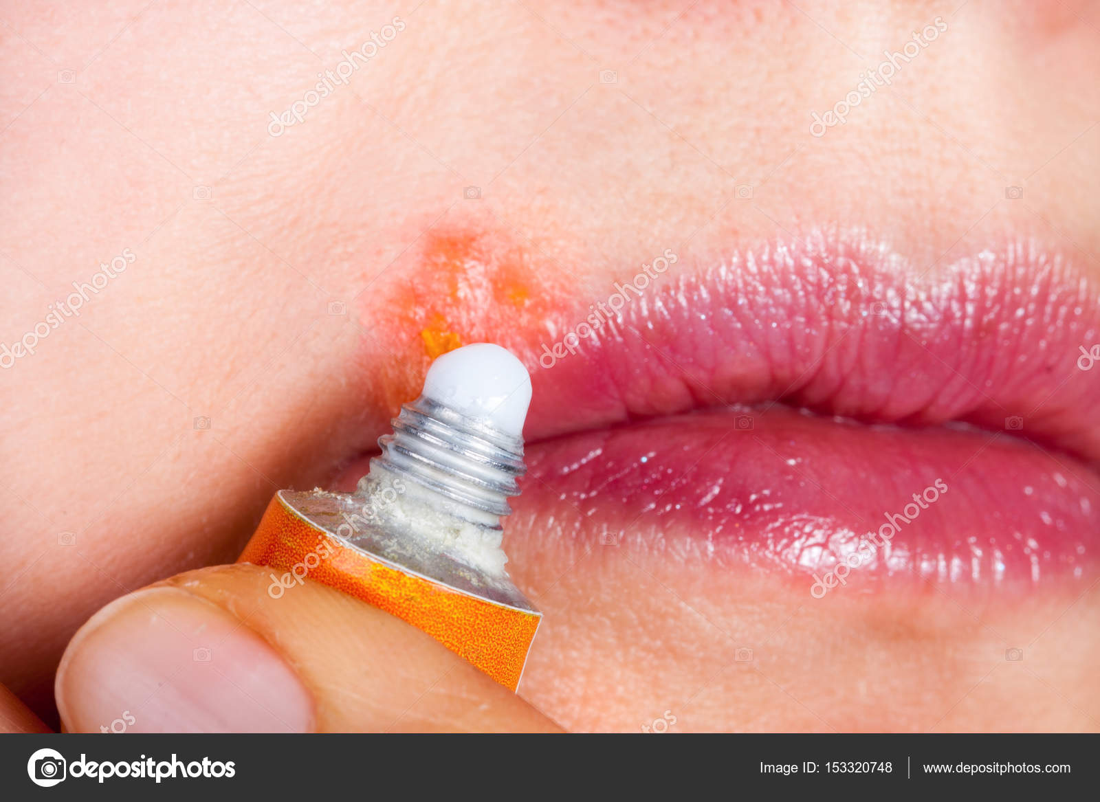 Herpes Auf Der Lippe Nahaufnahme Makro Frau Schmiert Die Labial