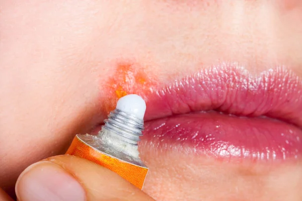 Έρπης σχετικά με τα lip κοντινής. Γυναίκα λιπαίνει την αλοιφή χειλική έρπητα — Φωτογραφία Αρχείου