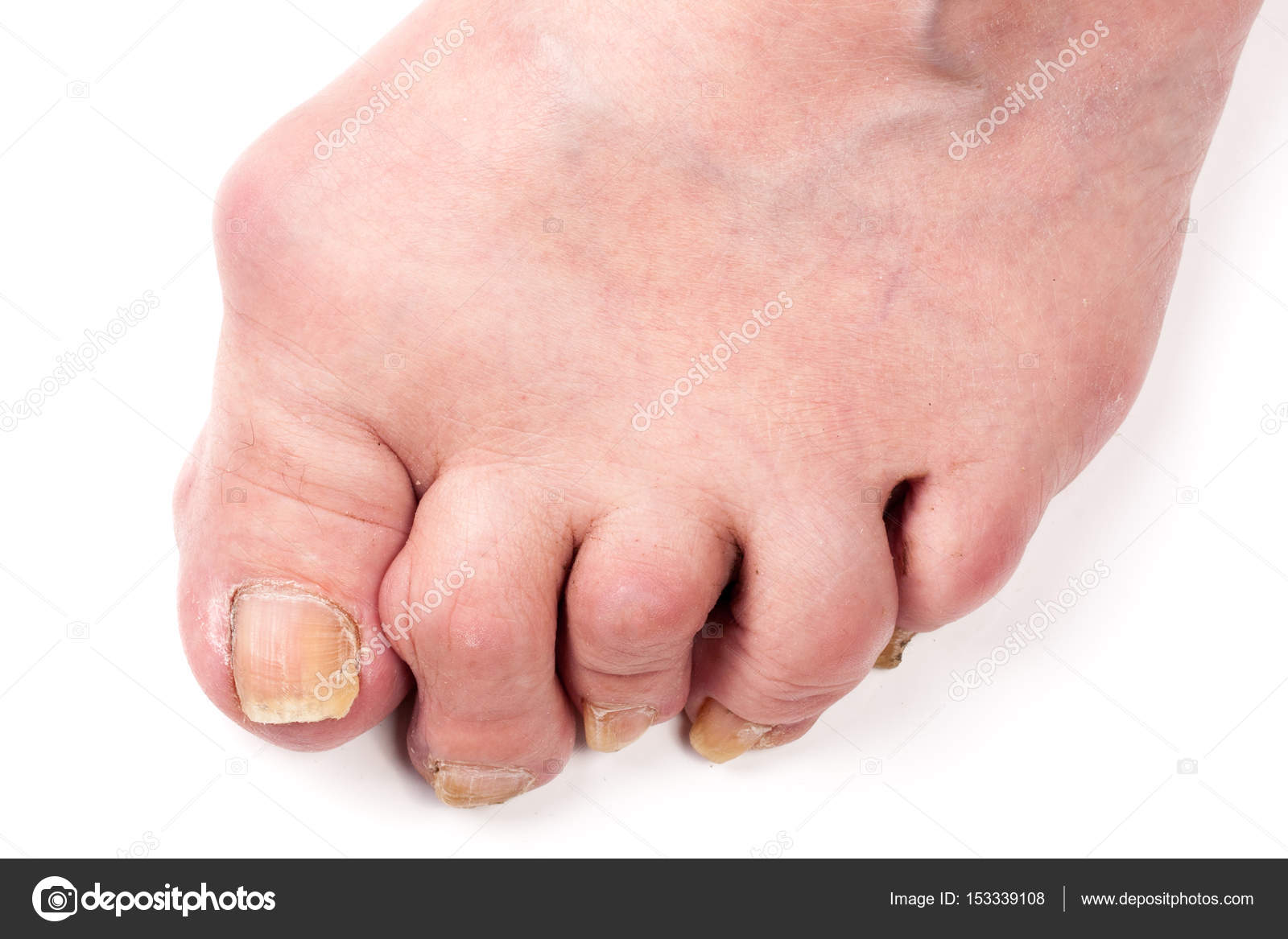 ревматоидный артрит голеностопного. артрит ног что делать. ревматоидный артроз голеностопного сустава. болезнь костей подагра. ахиллово сухожилие и ревматоидный артрит.