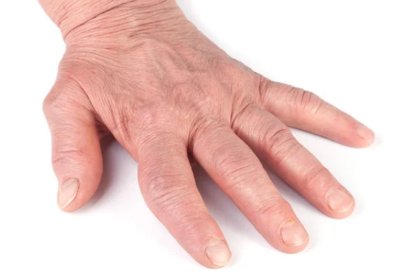 Poliartrite reumatoide delle mani isolate su sfondo bianco — Foto Stock