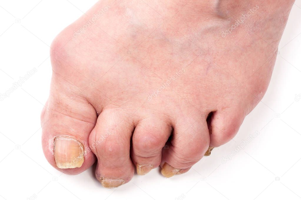 Rheumatoid polyarthritis on foot isolated on white background