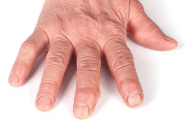 Rheumatoid polyarthritis of hands isolated on white background clipart