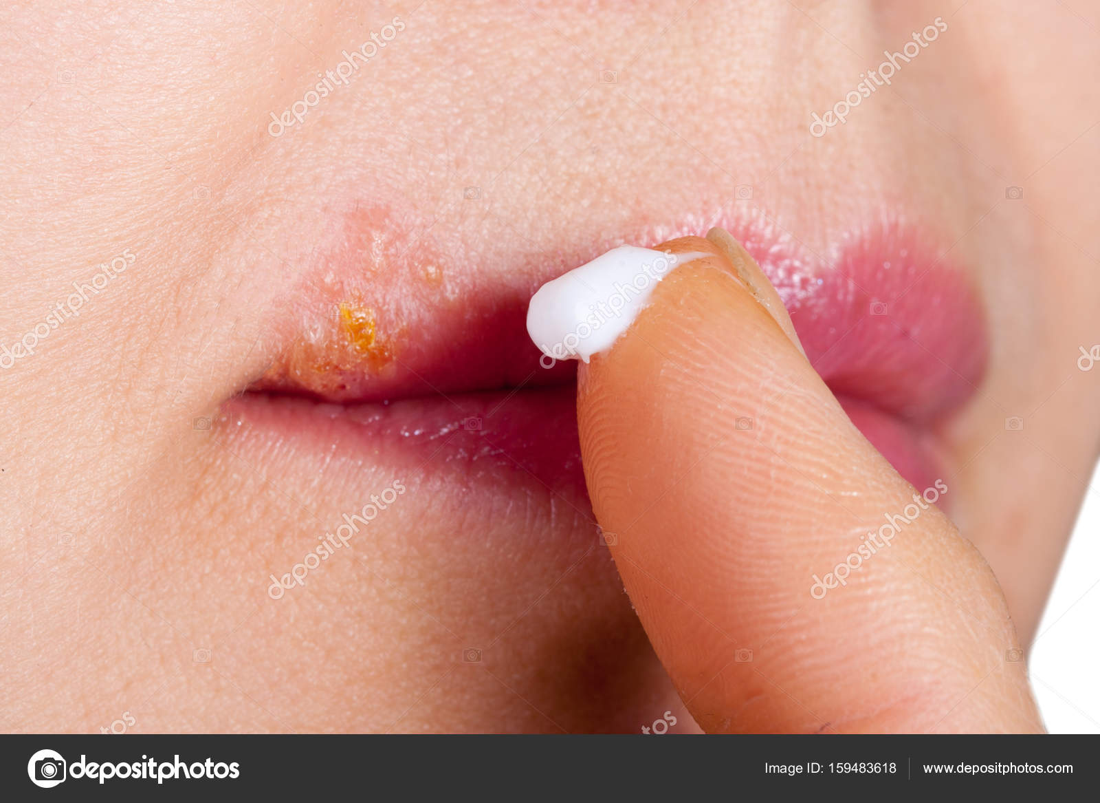 Pomada herpes na boca