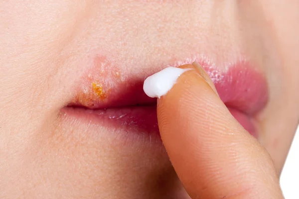 Έρπης σχετικά με τα lip κοντινής. Γυναίκα λιπαίνει την αλοιφή χειλική έρπητα — Φωτογραφία Αρχείου