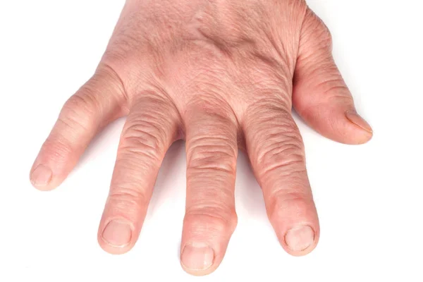 Rheumatoid polyarthritis of hands isolated on white background — Stock Photo, Image