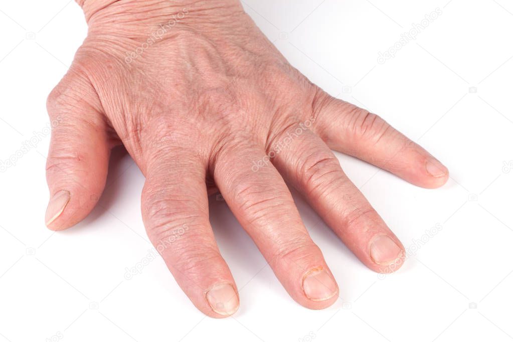 Rheumatoid polyarthritis of hands isolated on white background