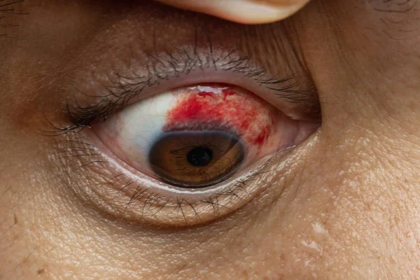 Blood in the eye from a subconjunctival hemorrhage usually disappears within a week or two.Human eye and blood close up. — Stock Photo, Image