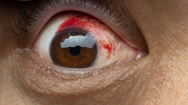 Blood in the eye from a subconjunctival hemorrhage usually disappears within a week or two.Human eye and blood close up.
