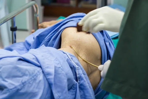 Böbrek Ameliyatından Kaynaklanan Nefrostomi — Stok fotoğraf