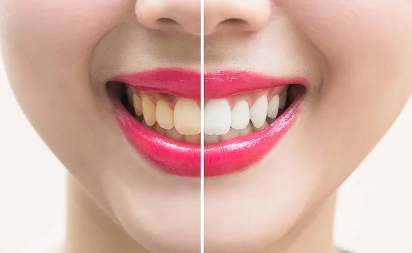 Perfektes Lächeln Zähne vor und nach dem Bleichen. Zahnaufhellung — Stockfoto
