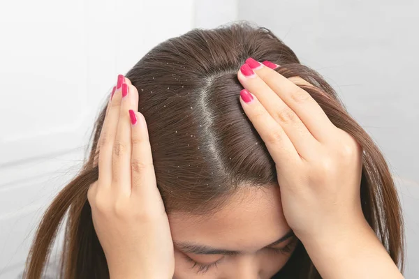 Cerrar el cabello en la caspa en el cabello femenino marrón . — Foto de Stock