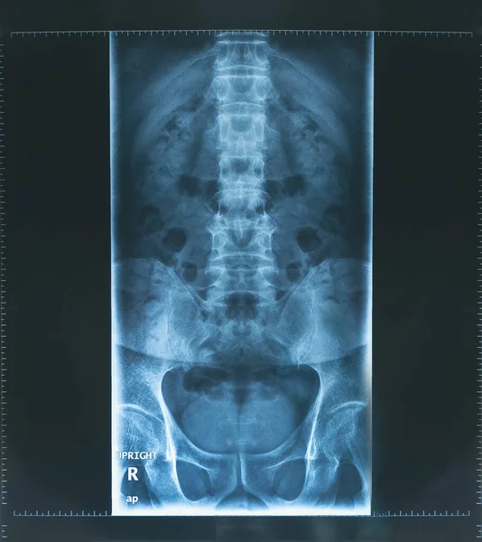 Ray Image Human Spine Apl View Blue Tone — Stock Photo, Image