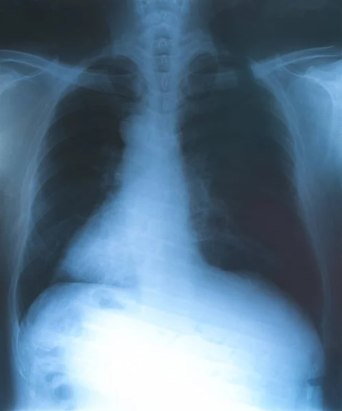Рентгеновская Пленка Легких Вирусом Ковид Концепция Заболевания Пневмонией — стоковое фото