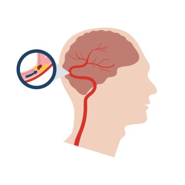 Vector illustration of a stroke clipart