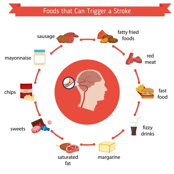 Infografías para derrame cerebral — Vector de stock