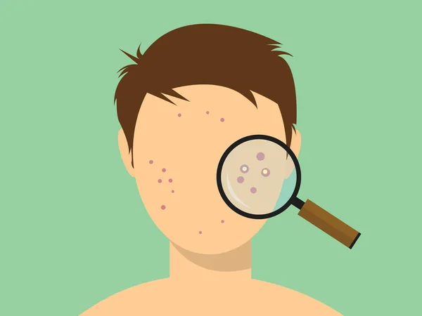 Human male acne face with magnifying glass — Stock Vector