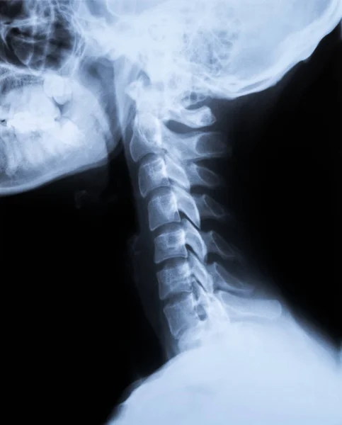 Röntgenfoto van de nek en schedel - zijaanzicht — Stockfoto