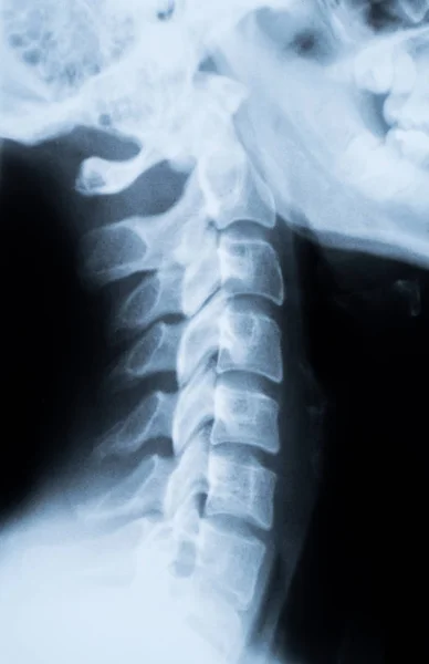Röntgenfoto van de nek en schedel - zijaanzicht — Stockfoto