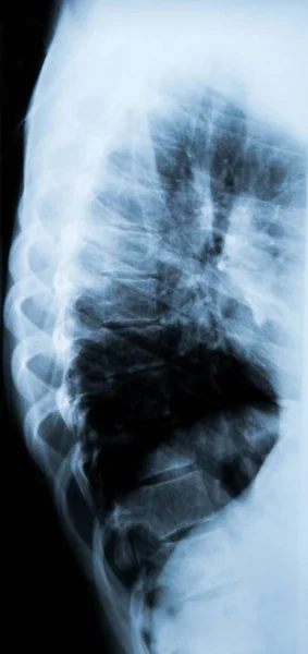 X-ray of the Backbone - side view — Stock Photo, Image