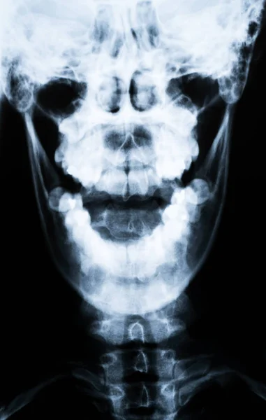 Рентген шеи и черепа - вид спереди — стоковое фото