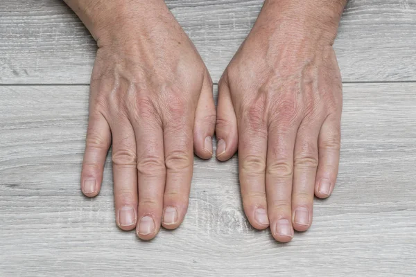 The back of a man\'s hands resting on a table side by side