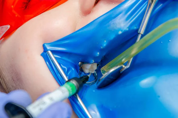 Tratamento dentário na odontologia. A boca está coberta com uma almofada de borracha azul — Fotografia de Stock