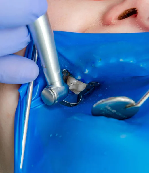 Leczenie zębów w stomatologii. Usta pokryte są niebieską gumową podkładką — Zdjęcie stockowe