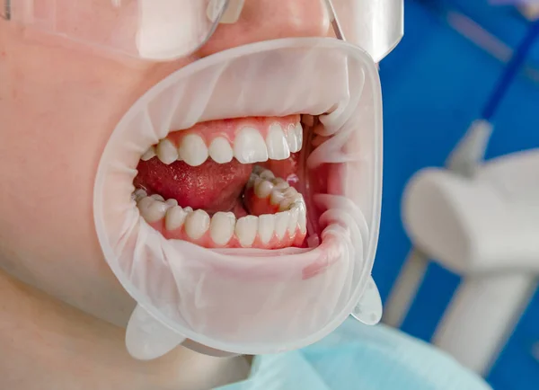 Zęby w ustach w klinice stomatologicznej, usta otwiera się zwijaczem policzkowym. — Zdjęcie stockowe