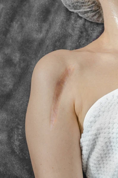 Vertikale Keloid Narbe Nach Knochenoperation Der Schulter Der Frau — Stockfoto