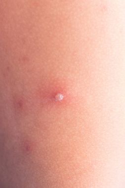 Kızamık döküntü