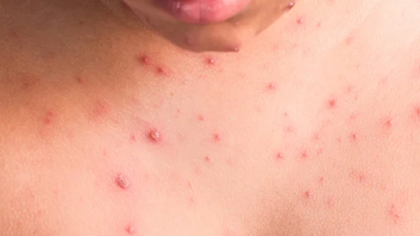 水痘発疹 — ストック写真
